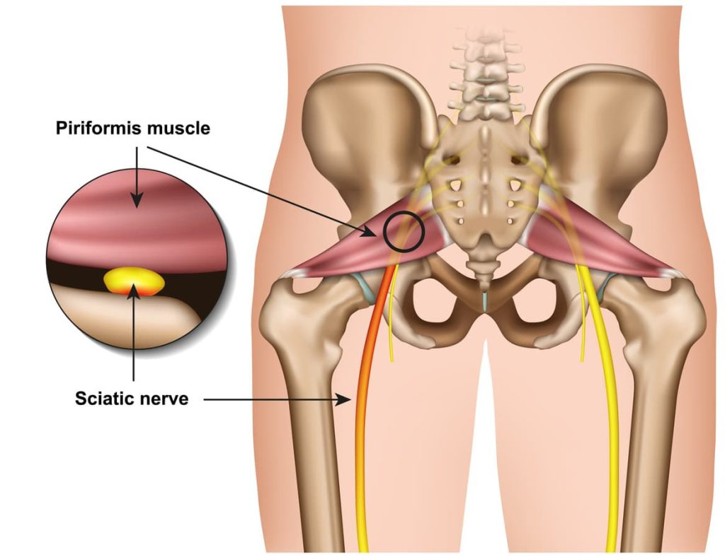 Piriforimis syndrome sciatica for website