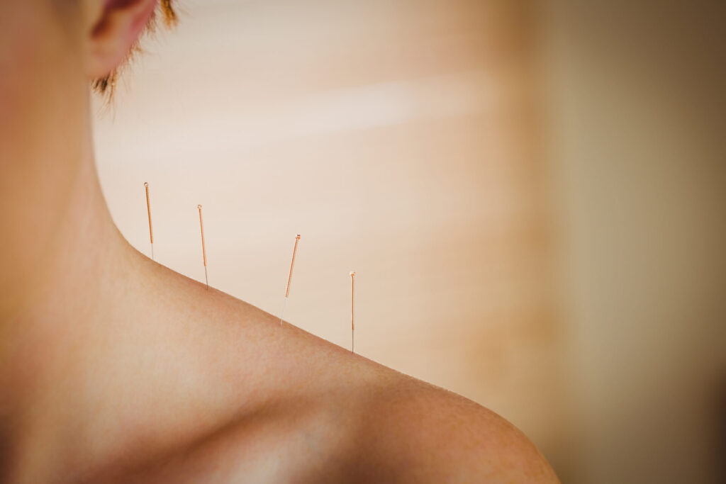 young woman getting acupuncture treatment in thera 2025 04 03 00 57 26 utc