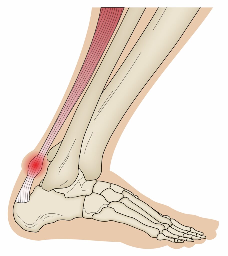 Achilles tendon