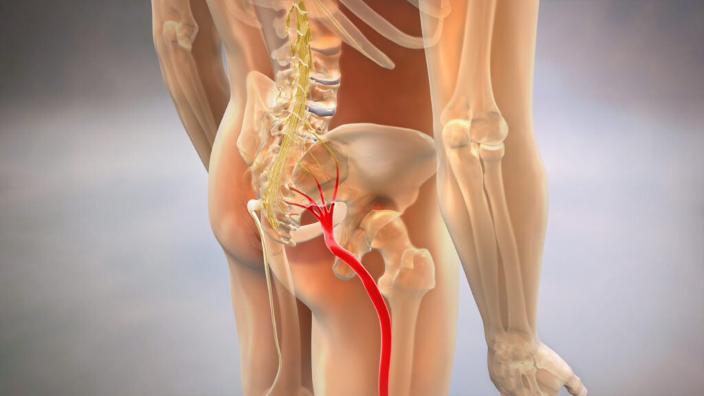 Sciatic pinched nerve