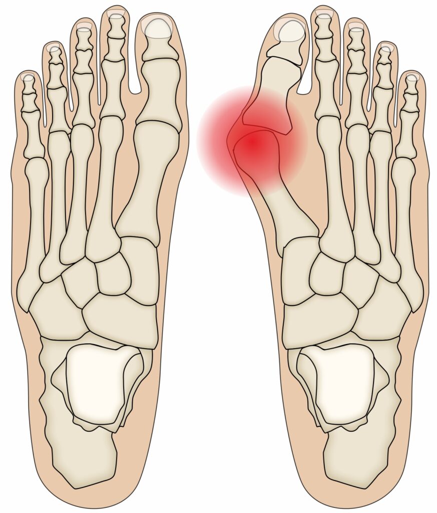 bunion