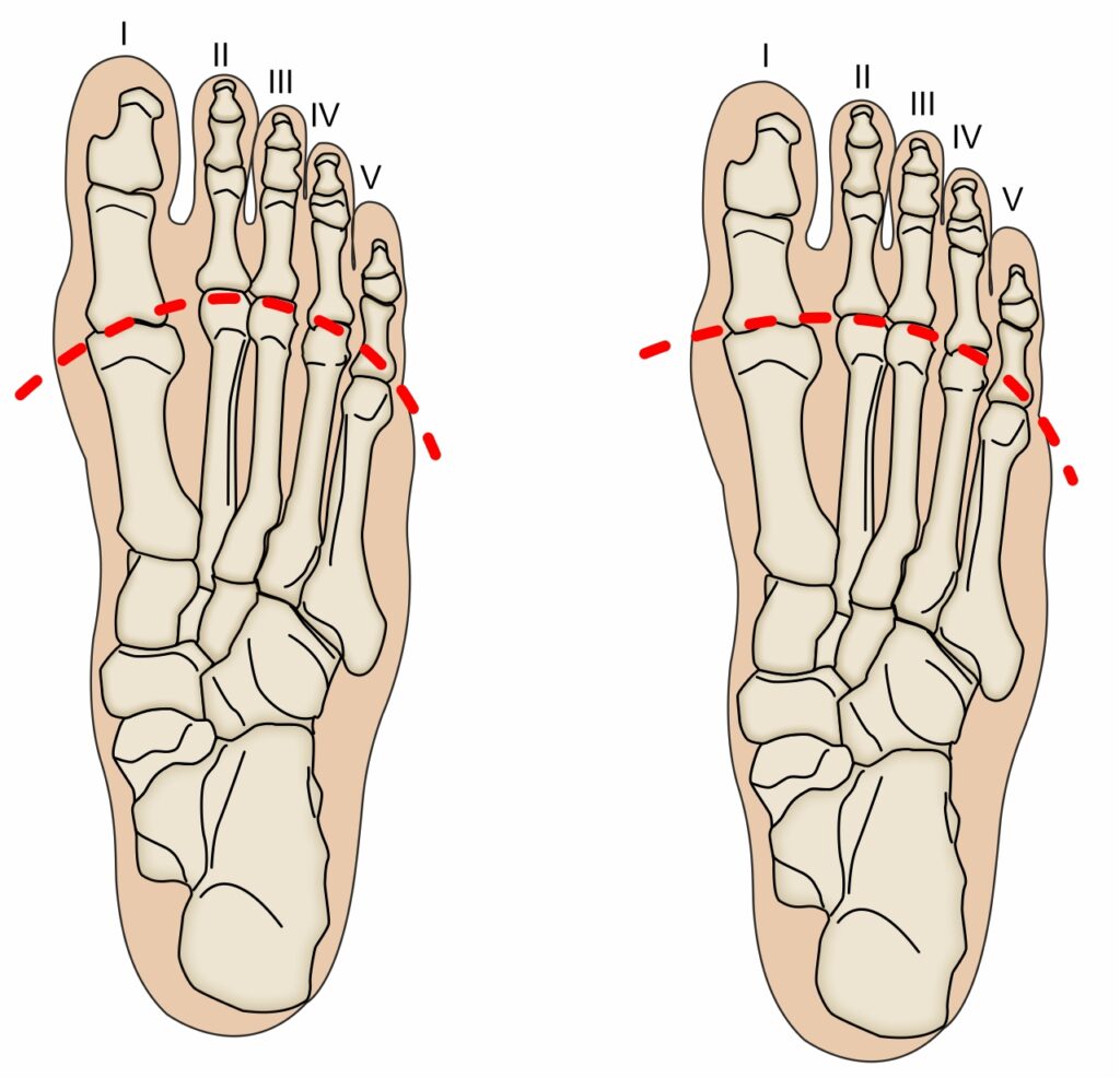 mortons foot
