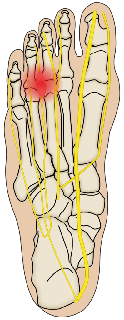mortons neuroma